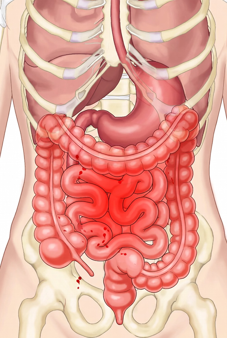 Síndrome del intestino irritable