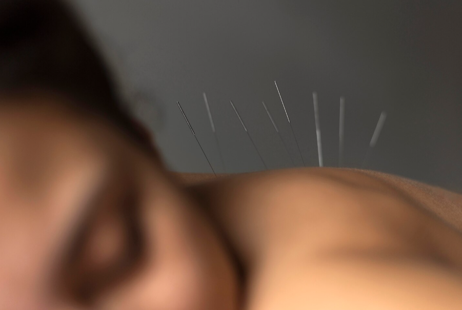 ¿Cómo funciona la acupuntura?