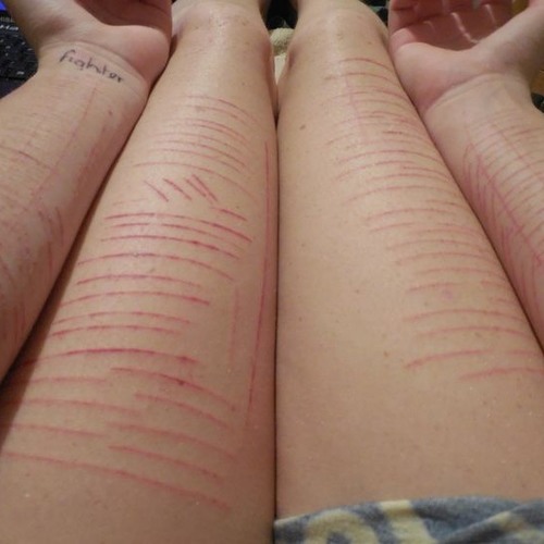 Lesión autolítica no suicida